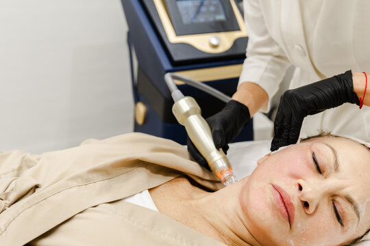 RF Microneedling Neck Rejuvenation Procedure