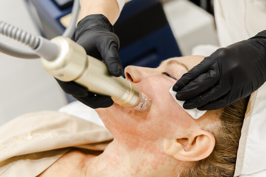 RF Microneedling Facial Treatment in Cosmetic Clinic