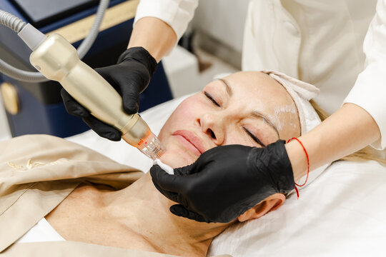 RF Lifting Facial Treatment in Beauty Clinic