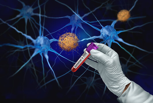 Alzheimers Blood test screening Diagnostics and Alzheimer Dementia analyzing for early detection of brain cognitive disorders as amyloid testing for protein biomarker as medical Alzheimer's