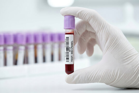 Gloved hand holding blood sample tube for EBV test in a medical laboratory