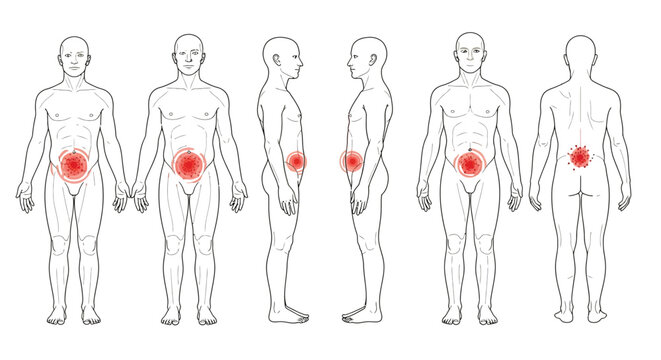 Vector graphic illustration of male anatomical outlines highlighting common prostate or lower abdominal and back pain.