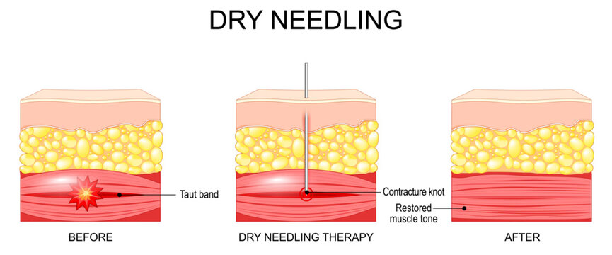 Dry needling. Skin and Muscle before and after dry needling therapy.