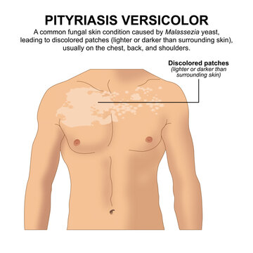 Pityriasis Versicolor, Skin flashcard illustration