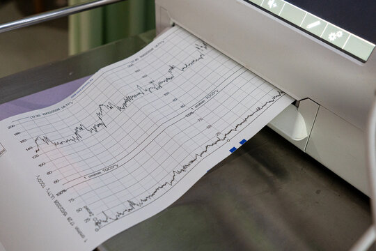 Cardiotocography CTG machine printing fetal heart rate and uterine contraction monitoring graph. Clinical medical equipment for pregnancy checkup and labor progress in a hospital.