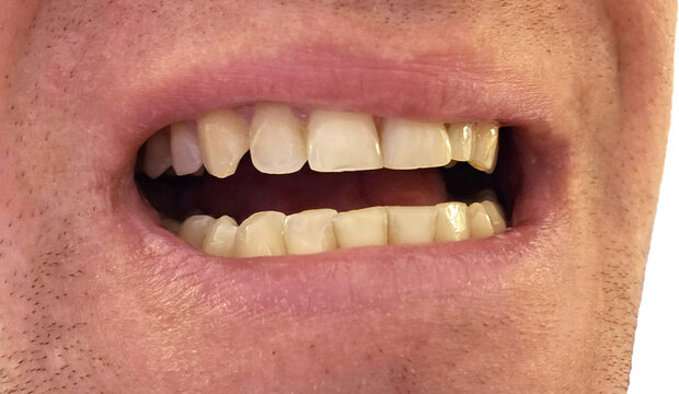 Close up of adult man mouth with crooked yellow teeth and malocclusion before orthodontic treatment. Dental problems, dental hygiene and stomatology concept.