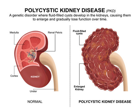 Polycystic Kidney Disease (PKD) Flashcard Illustration