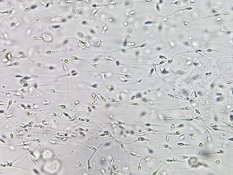 Sperm analysis on microscopic examination, Normozoospermia, normal semen analysis.
