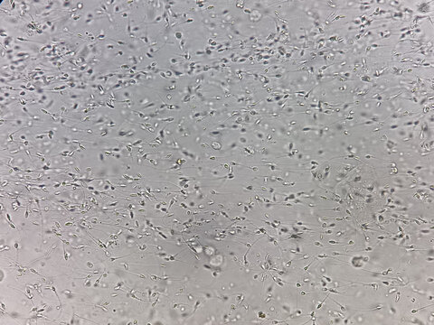Sperm analysis on microscopic examination, Normozoospermia, normal semen analysis.