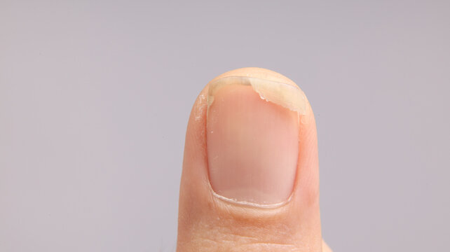 Close up view of a fingernail showing splitting or brittleness