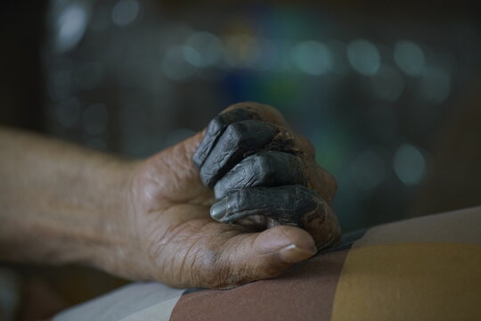 showing third-degree frostbite, or congelatio gangraenosa, on a human hand. This is the most severe stage of frostbite.  Congelatio gangraenosa involves irreversible damage to the skin, muscles