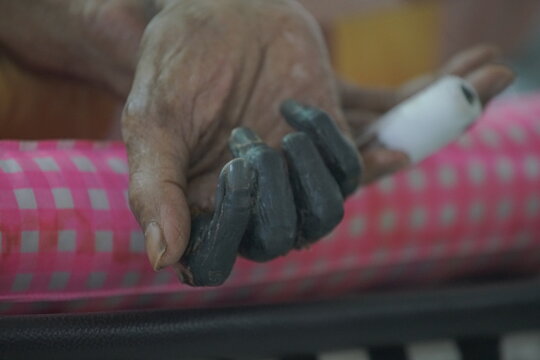 showing third-degree frostbite, or congelatio gangraenosa, on a human hand. This is the most severe stage of frostbite.  Congelatio gangraenosa involves irreversible damage to the skin, muscles