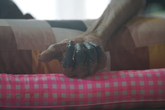 showing third-degree frostbite, or congelatio gangraenosa, on a human hand. This is the most severe stage of frostbite.  Congelatio gangraenosa involves irreversible damage to the skin, muscles