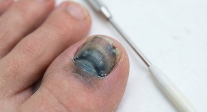 Macro view of bruised toenail with jogger's toe symptoms