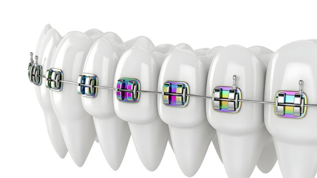 Close up of straightening teeth with colorful braces and dental archwire