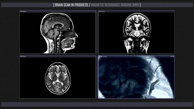 Dynamic screen of magnetic resonance imaging of the brain. Brain scan in progress