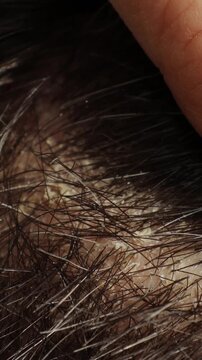Scalp dandruff and seborrheic dermatitis examination. Closeup of flaky itchy head skin with hair, vertical video