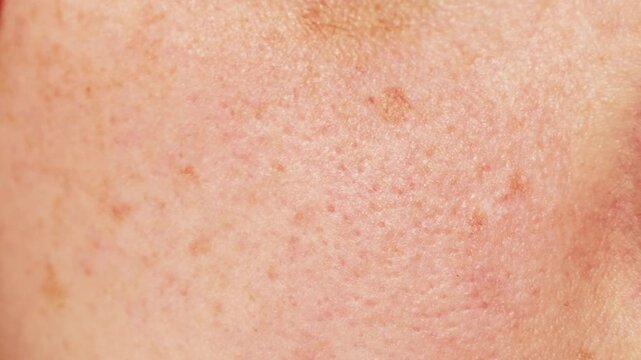 Human skin with freckles and moles, showing natural texture and pigmentation