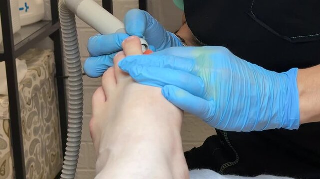 Close-up podiatry treatment toenail using diamond drill and blue gloves doctor files infected nail while patient sits.