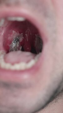 Close-up of Throat and Tonsil Bed Recovery After Tonsillectomy Surgery