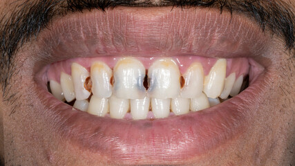 Front view of a patient's dental arches in biting occlusion. Showing interproximal carious lesions on the maxillary central and lateral incisors, and the canine with associated enamel discoloration. © MSC