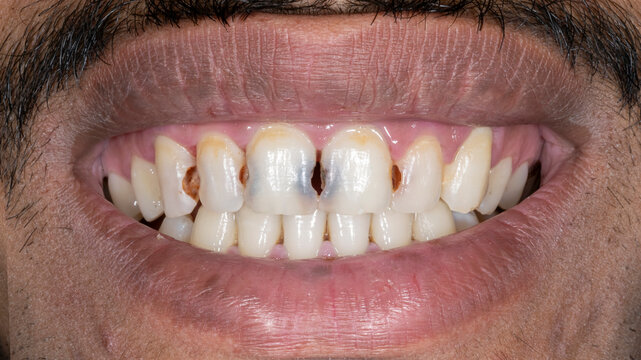 Front view of a patient's dental arches in biting occlusion. Showing interproximal carious lesions on the maxillary central and lateral incisors, and the canine with associated enamel discoloration.