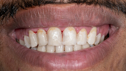 Front view of a patient's teeth smiling. Showing interproximal resin composite aesthetic restorations on the maxillary central and lateral incisors, and the canine, with post operative bleeding gums. © MSC