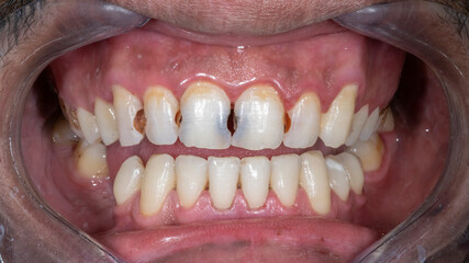 Front view of a patient's dental arches in open occlusion. Showing interproximal carious lesions on the maxillary central and lateral incisors, and the canine with associated enamel discoloration. © MSC