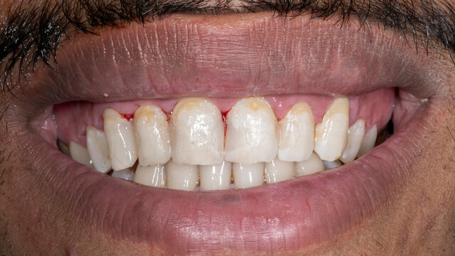 Front view of a patient's teeth smiling. Showing interproximal resin composite aesthetic restorations on the maxillary central and lateral incisors, and the canine, with post operative bleeding gums.