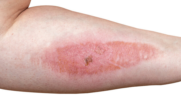 Burn on female arm skin close up macro isolated on white background.