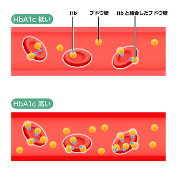 血管の中のHbA1cの状態のイラスト