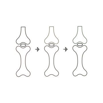 Illustration of progressive knee joint replacement or bone fracture healing stages