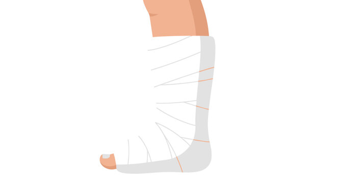 Illustration of a leg wrapped in a white plaster cast against a plain background, showcasing medical support and healing process