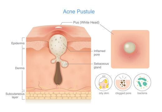 Skin layer anatomy of Acne pustule (whitehead). Clogged pore filled with pus can see at skin surface, Inflamed pore. Icon of cause of this acne problem included oily skin, bacteria and clogged pore.