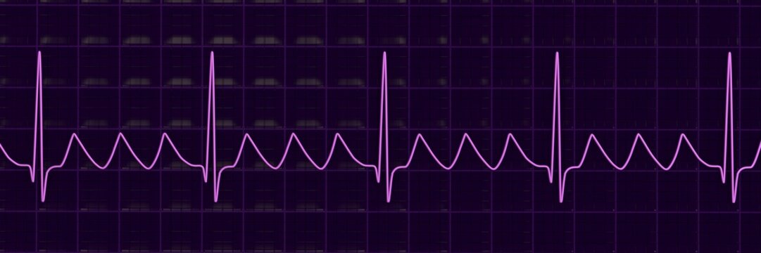Atrial flutter ECG, 3D illustration, electrocardiogram tracing showing regular sawtooth flutter waves between QRS complexes.
