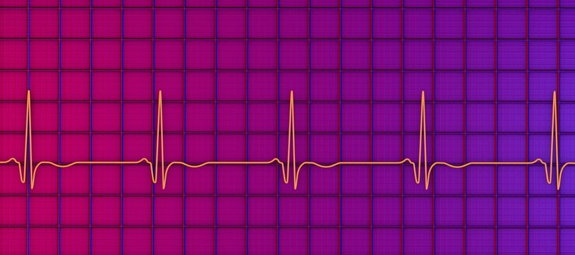 Chronic Q wave ECG, 3D illustration, electrocardiogram pattern showing persistent pathological Q wave and chronic myocardial scar after infarction.