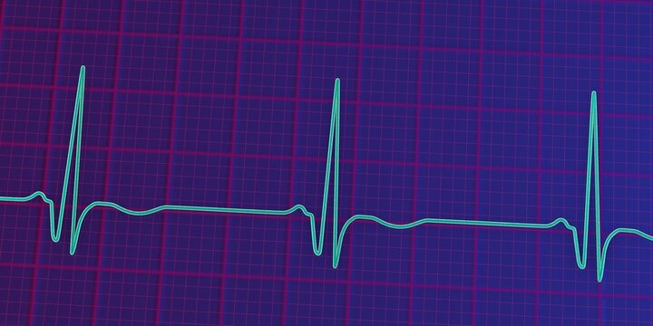 Chronic Q wave ECG, 3D illustration, electrocardiogram pattern showing persistent pathological Q wave and chronic myocardial scar after infarction.