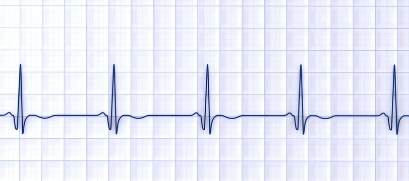 Chronic Q wave ECG, 3D illustration, electrocardiogram pattern showing persistent pathological Q wave and chronic myocardial scar after infarction.