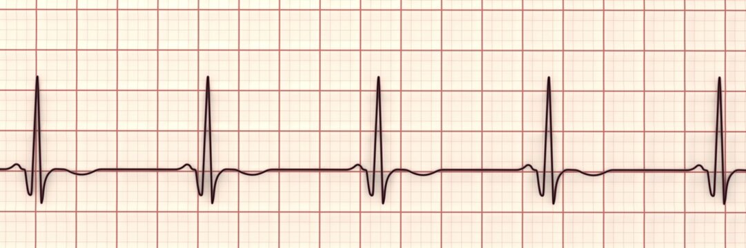 Chronic Q wave ECG, 3D illustration, electrocardiogram pattern showing persistent pathological Q wave and chronic myocardial scar after infarction.