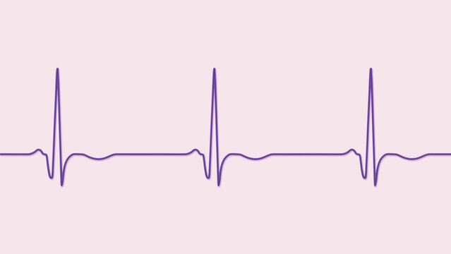 Chronic Q wave ECG, 3D illustration, electrocardiogram pattern showing persistent pathological Q wave and chronic myocardial scar after infarction.