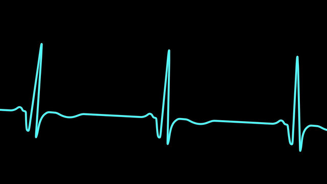 Chronic Q wave ECG, 3D illustration, electrocardiogram pattern showing persistent pathological Q wave and chronic myocardial scar after infarction.