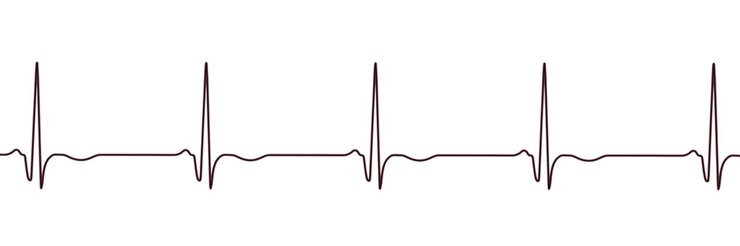 Chronic Q wave ECG, 3D illustration, electrocardiogram pattern showing persistent pathological Q wave and chronic myocardial scar after infarction.