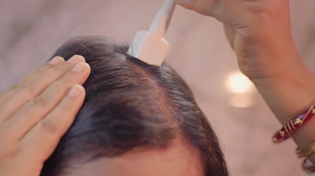 Close up shot of a woman using derma stamp on bald area to stimulate hair follicles, microneedling treatment for hairloss.