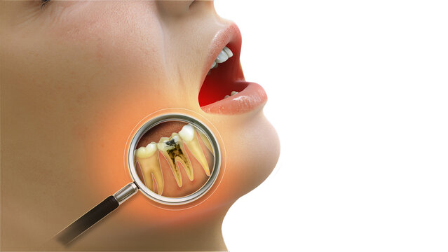 Root canal infection