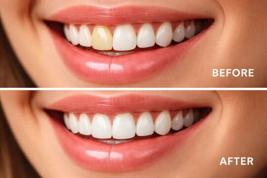 Before and after image of dental crown replacement showing beautiful all ceramic crown with copy space