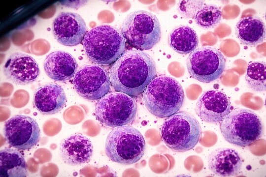 Blood smear microscopy revealing chronic lymphocytic leukemia indicators