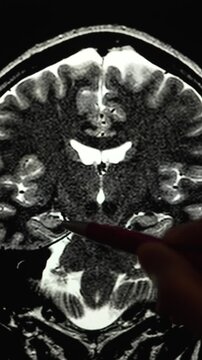 A brain MRI displayed on a screen, showing a coronal T2-weighted slice. A hand holding a pen points to the hippocampal region, illustrating neuroanatomy and memory-related structures