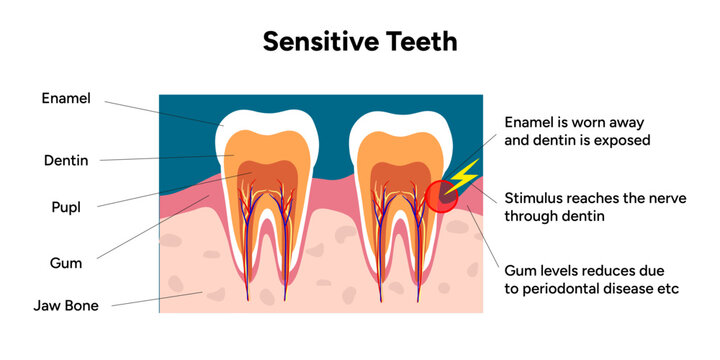 Hand-drawn illustration of tooth sensitivity anatomy in educational style. Tooth structure, exposed dentin, enamel wear, and nerve pathways that cause sensitivity 