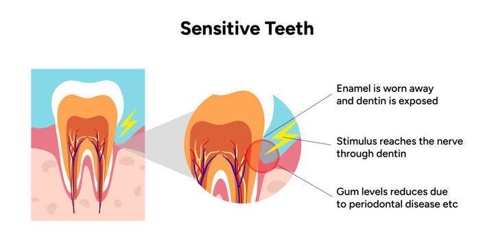 Hand-drawn illustration of tooth sensitivity anatomy in educational style. Tooth structure, exposed dentin, enamel wear, and nerve pathways that cause sensitivity 
