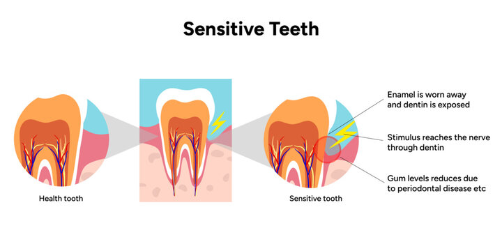 Hand-drawn illustration of tooth sensitivity anatomy in educational style. Tooth structure, exposed dentin, enamel wear, and nerve pathways that cause sensitivity 
